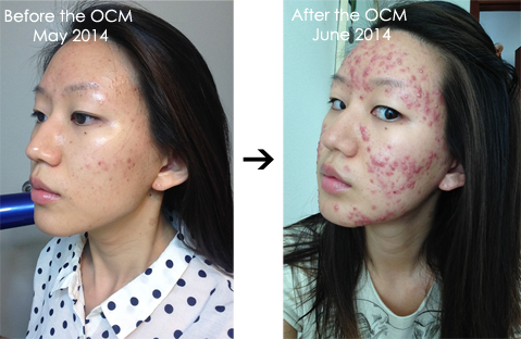 OCM Before After
